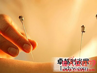 什麼是針灸減肥?