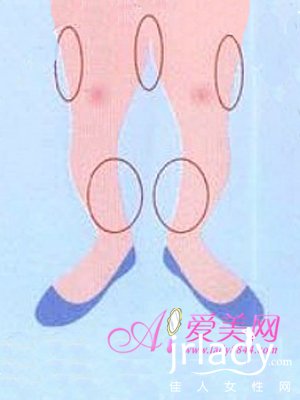 瘦腿操+生活改造 糾正惱人O型腿