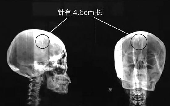 女子腦裡藏針46年怎麼插進去的 將接受開顱手術需要多少錢