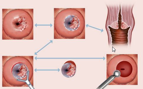 什麼人容易得宮頸糜爛 經期過長會導致宮頸糜爛嗎 經期過長吃什麼藥調理