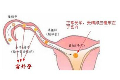 導致宮外孕的原因 警惕婦科炎癥