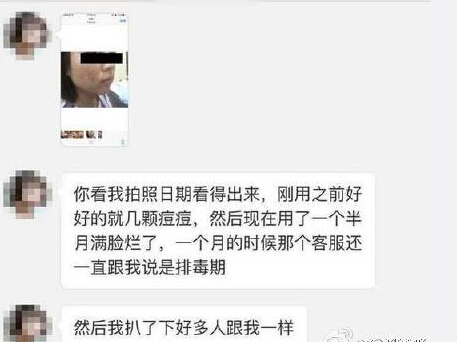 張庭活酵母面膜怎麼樣?為什麼會爛臉? 張庭活酵母面膜怎麼樣?為什麼會爛臉?
