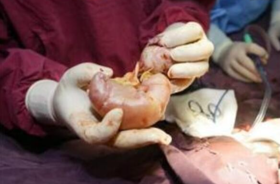 15歲少女腹中藏嬰15年 原是胎中胎藏孿生妹妹或弟弟