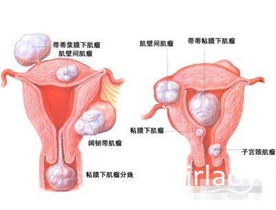 子宮肌瘤手術後有哪些註意事項?