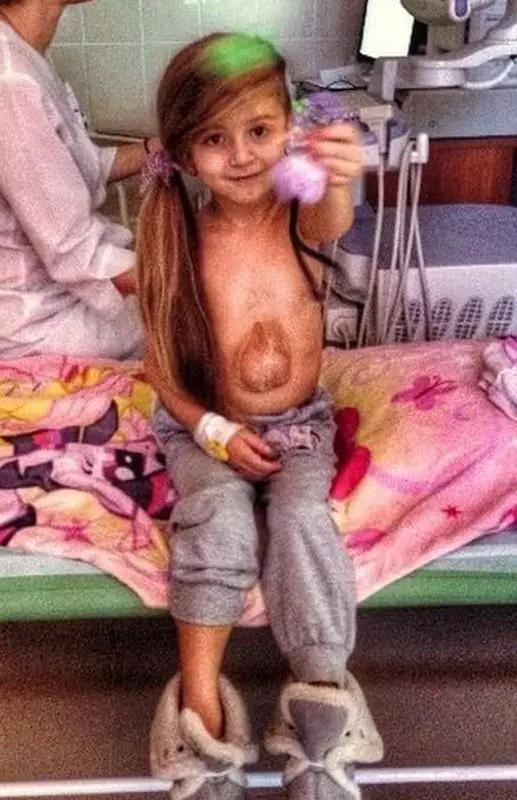 俄5歲女孩心臟長在胸腔外僅一層皮膚保護 心臟外露能活多久