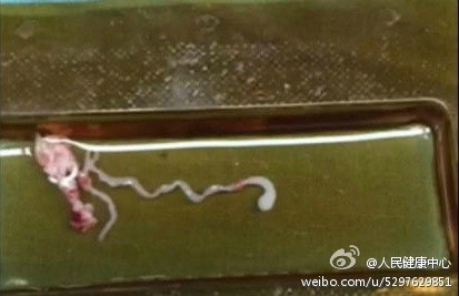 男童腦中取出8厘米裂頭蚴寄生蟲 裂頭蚴怎麼殺死在人體內怎麼辦