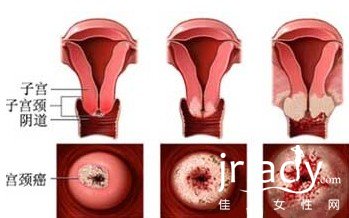 宮頸癌的治療方法大盤點