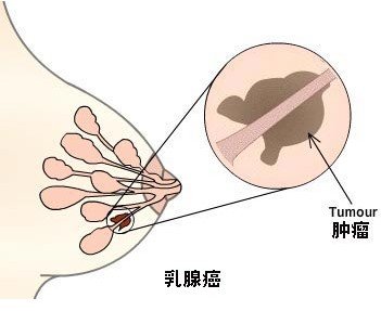 乳腺小葉增生與乳腺癌的主要區別是什麼?