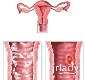 滴蟲性陰道炎有哪些癥狀
