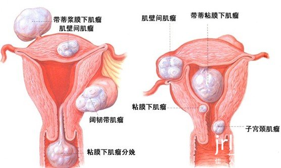 子宮肌瘤患者不可盲目飲食