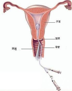 婦科癌癥的常識性問題